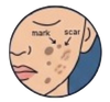 Acne Marks / Acne Scars