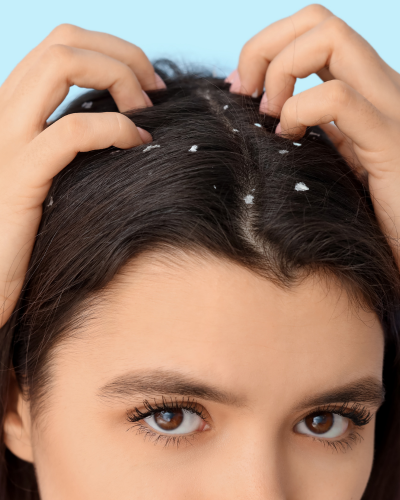 DANDRUFF + ITCHY SCALP