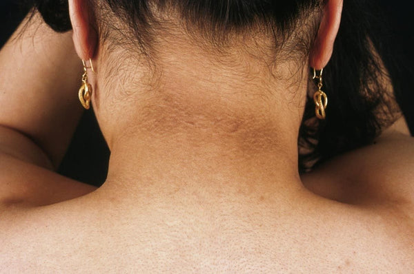 Neck Pigmentation