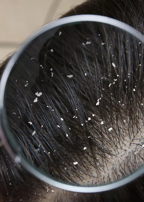 DANDRUFF + ITCHY SCALP