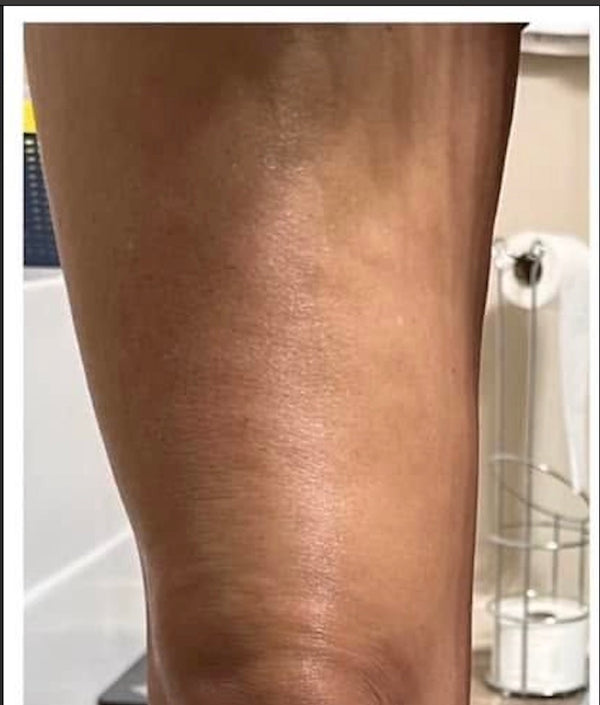 INNER THIGH PIGMENTATION