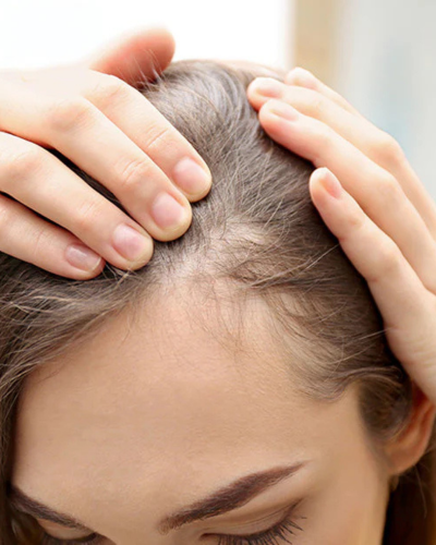 POSTPARTUM HAIR LOSS