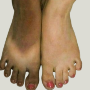 FOOT PIGMENTATION